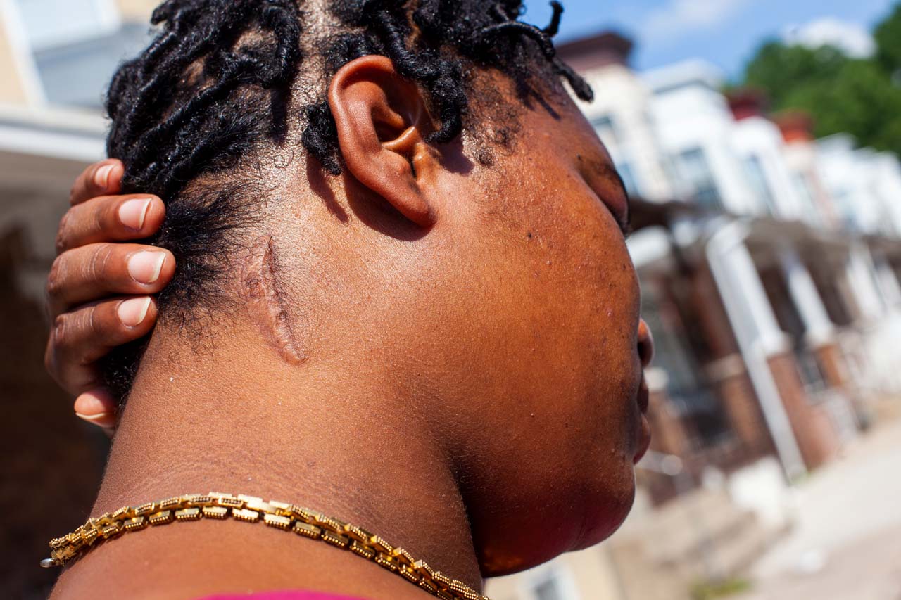 Woman with scar on her neck